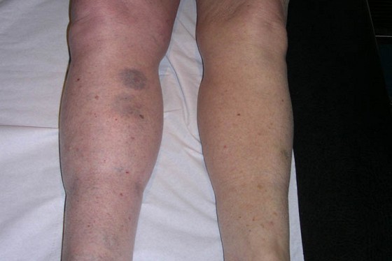 Trombolititcheskaya la thérapeutique des thromboses veineuses