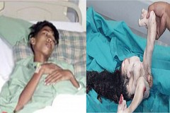 Malaisie : Il se fait retirer une tumeur de l'estomac constituée de cheveux, de membres et d'organes génitaux
