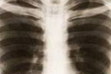 Tuberculose : Le Fonds mondial équipe les CAT...