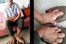 Un homme de 27 ans trouve enfin une paire de chaussures pour ses énormes pieds