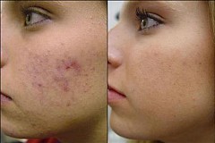  Comment faire partir les cicatrices d'acné