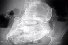 Enceinte d'un fœtus pétrifié depuis 40 ans Enceinte d'un fœtus pétrifié depuis 40 ans