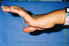 Un chirurgien opère le mauvais doigt d'une femme. Un chirurgien opère le mauvais doigt d'une femme.