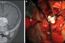 Des dents retrouvées dans le cerveau d'un bébé