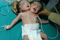 (Vidéo+Photos) Un bébé à deux têtes nait en Inde: ses parents n'avaient pas l'argent pour payer l'écographie qui aurait pu déceler le problème