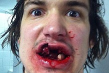Un hockeyeur défiguré après avoir reçu un palet sur la bouche