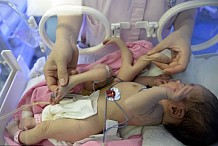 Un bébé né avec 4 bras et 4 jambes suite à la mort in utero de son frère siamois qui n'était pas entièrement développé 