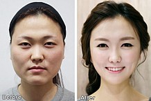 La chirurgie plastique est si efficace en Corée du Sud qu'ils ont besoin de certificats pour prouver qui ils sont