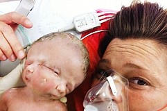 Des sœurs siamoises nées en Australie: les parents, prévenus au cours du 5e mois, n'ont pas voulu interrompre la grossesse Des sœurs siamoises nées en Australie: les parents, prévenus au cours du 5e mois, n'ont pas voulu interrompre la grossesse