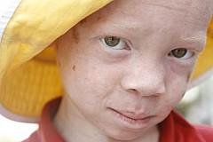 Tanzanie: Un albinos tué par des sorciers pour ses organes