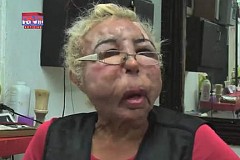 Défiguré par des injections au visage d'huile pour bébé Défiguré par des injections au visage d'huile pour bébé