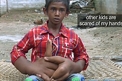 (Vidéo) Inde: Ce petit garçon a des mains de 12 kg