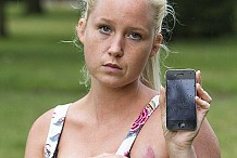 (Photos) L'iPhone de cette jeune femme a brûlé sur son sein gauche alors qu'elle dormait