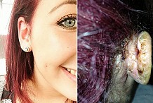 (Photos) Une ado perd une partie de son oreille suite à une terrifiante infection!