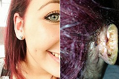 (Photos) Une ado perd une partie de son oreille suite à une terrifiante infection! (Photos) Une ado perd une partie de son oreille suite à une terrifiante infection!