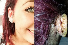 (Photos) Une ado perd une partie de son oreille suite à une terrifiante infection!