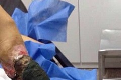 Cette fille de 13 ans a une jambe qui ressemble à un tronc d'arbre: elle est nécrosée à cause du venin d'un serpent Cette fille de 13 ans a une jambe qui ressemble à un tronc d'arbre: elle est nécrosée à cause du venin d'un serpent