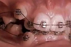 (Vidéo) L'avant/après appareil dentaire époustouflant