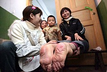 Chine : Une femme naît avec des pieds et des mains en arrière