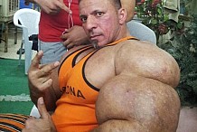 (Photos) Cet homme s'est injecté du synthol pour paraître plus musclé