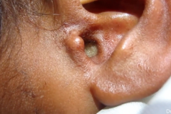 (vidéo) Un indien se fait retirer une centaine d’asticots de son oreille (vidéo) Un indien se fait retirer une centaine d’asticots de son oreille