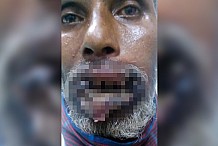 (Vidéo) Inde: Un homme a des asticots dans les lèvres