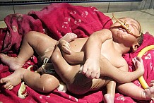 Ce bébé naît avec huit membres: un garçon 