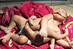 Ce bébé naît avec huit membres: un garçon Ce bébé naît avec huit membres: un garçon
