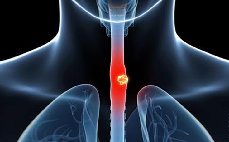 Cancer de l’œsophage : combien mesurez-vous ? - LeBabi.net