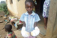 Côte d'Ivoire: Une maitresse plonge les mains d'une élève dans l'eau bouillante pour la punir