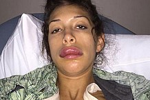 (Photos) Farrah Abraham et son opération ratée des lèvres