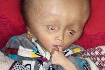 (Photos) La famille de Cao, 3 ans, est désespérée: sa tête ne cesse de grossir et a déjà atteint le double de sa taille normale à cause de sa maladie