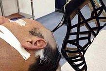 Arabie Saoudite: Un homme se retrouve à l'hôpital avec un talon aiguille planté dans la tête