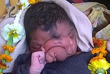 Inde: Un enfant naît avec une trompe d'éléphant