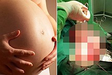 (Photo) Roumanie: Se croyant enceinte, elle accouche d'une énorme tumeur