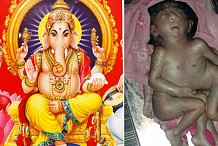 Inde: Naissance d'un bébé à 4 pieds et 4 bras