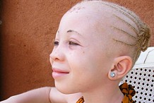 (Photos) Les albinos de l'Afrique de l'est sont pourchassés pour des ''rituels magiques''