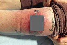 (Photos) Son tatouage en l'honneur de ses petits enfants s'infecte et ravage sa peau, elle a dû se faire opérer