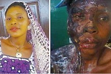 Nigéria: Il agresse son ex-copine à l'acide parce qu'elle a refusé de quitter la maison qu'il louait pour elle