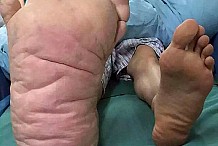 (Photos) Chine: Il possède un pied plus gros que l'autre....
