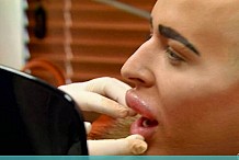 (vidéo) Ses lèvres menacent d'exploser à cause des injections de botox