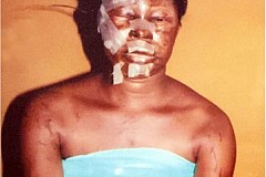 Nigeria: Il verse de l'acide sur son ex-épouse pour se venger