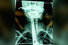 Une femme s'insère une spatule de 30 cm dans la gorge et s'en sort miraculeusement Une femme s'insère une spatule de 30 cm dans la gorge et s'en sort miraculeusement