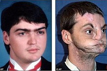 Après avoir reçu une balle dans la tête, Richard se retrouvait défiguré: 20 ans plus tard, on lui a greffé le visage d'un inconnu 