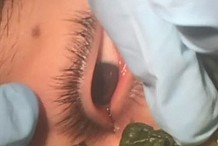 (Vidéo) Un ado se fait retirer une larve nichée dans son œil sans intervention chirurgicale