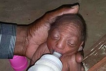 (Photos) Une mère rejette son bébé né avec des malformations.