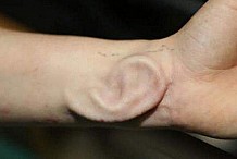 (Photo) Elle se fait greffer une oreille cultivée dans son bras