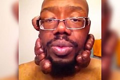 Cet homme a le visage recouvert de chéloïdes Cet homme a le visage recouvert de chéloïdes