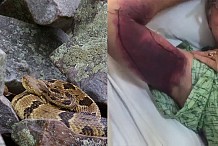 (Vidéo) Il prend un selfie avec un serpent, se fait mordre, et finit avec 150 000 dollars de facture d'hôpital