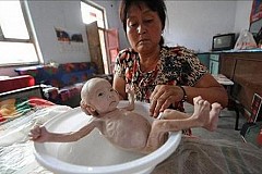Ce nourrisson est appelé le «bébé alien»: l'enfant est né sans rectum